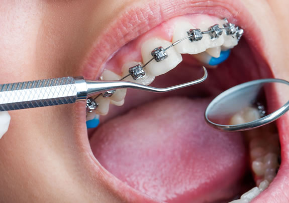 tratamientos de ortodoncia en Madrid