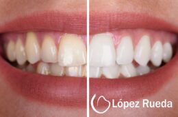 Blanqueamiento dental en Madrid: todo lo que necesitas saber