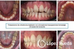 Caso clínico Invisalign: antes y después | Clínica López Rueda