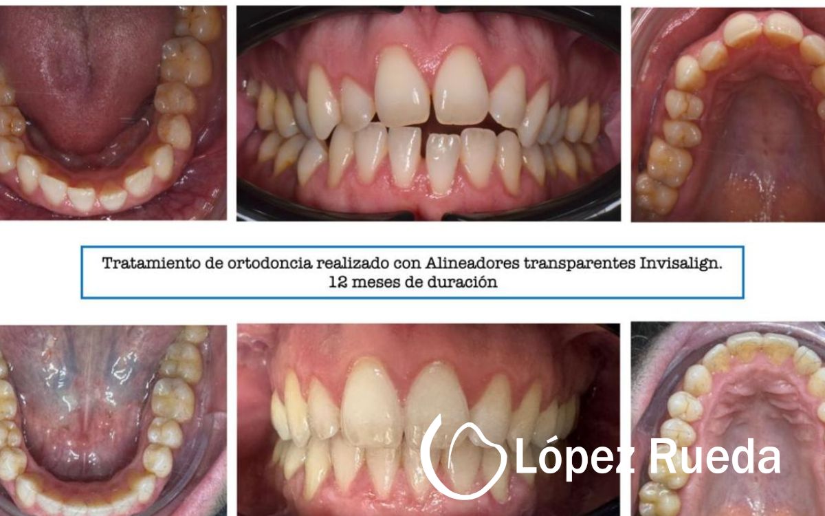 caso-clinico-invisalign-ortodoncia-invisible-madrid